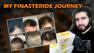 I REJECTED BALDNESS  My Hair Loss Story and Finasteride [upl. by Ruffina704]