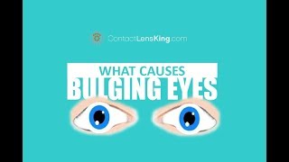 BULGING EYES  Causes Symptoms and Treatment  Exophthalmos Exopthalmia Exorbitsm and Proptosis [upl. by Soirtemed563]