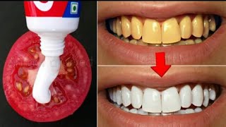 Magical Teeth Whitening Remedy Get whiten Teeth at home in 2 minutes [upl. by Dronel32]