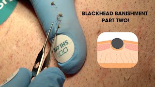 Blackhead Banishment Part Two Super Satisfying Blackhead Squeeze [upl. by Dedrick]