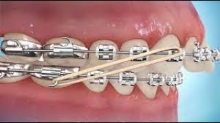 How to put on Class II Elastics [upl. by Swope]