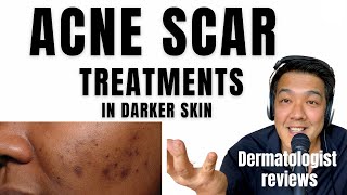 ACNE SCAR TREATMENTS  In Ethnic Skin [upl. by Dosia]