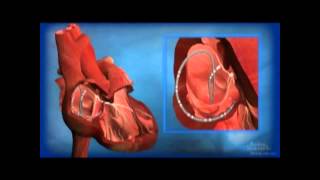 Ablation for AV Node Reentrant Tachycardia AVNRT [upl. by Roch]