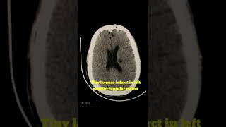 Lacunar Infarct in left gangliocapsular region radiology shortvideo ct brain [upl. by Nets185]