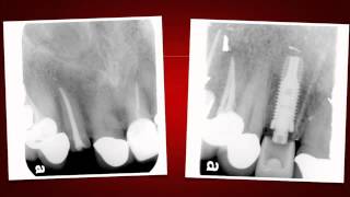 Implant Case 7  Dr Tarun Agarwal Part 10 Post OP xray [upl. by Hendry864]