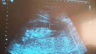 Ultrasound guided ESWL [upl. by Oloapnaig]