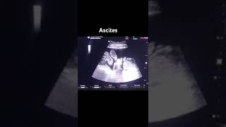 Ultrasound  Ascites Utrasound video [upl. by Scheers595]