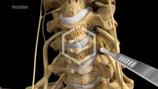 c5c6c7 Anterior Cervical Discectomy with Fusion [upl. by Scribner]