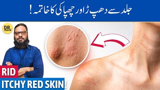 KharishDhapper Ka Ilaj  Treat UrticariaHives on Skin  Dr Ibrahim [upl. by Ffoeg]