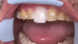 Houston Cosmetic DentistStep by step procedure for Porcelain VeneersConservative preps [upl. by Consuela]