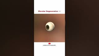 Macular Degeneration OR Agerelated macular Degeneration AMD  Animation [upl. by Purity]