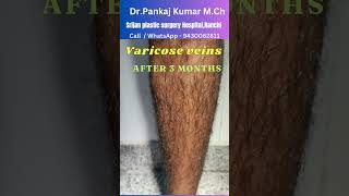 Varicose veins treatment  Result after 3 months Best varicose veins treatment for SSC GD medical [upl. by Ettenahc]