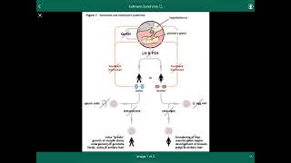 Kallmann Syndrome  متلازمة كولمان [upl. by Brass]