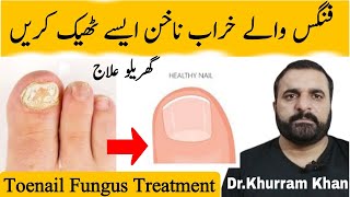 Toenail Fungus Treatment خراب ناخن کا علاج  DrKhurram RPh  toenailfungustreatment [upl. by Rachele]