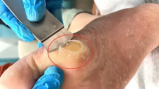 Callus removal from feetampFoot scraping dead skin【Xiao Yan pedicure】stress 809 [upl. by Xxam]