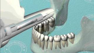 Técnica indirecta en el bloqueo regional mandibular [upl. by Fawcette]