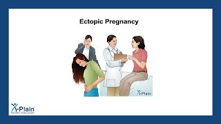 Ectopic Pregnancy [upl. by Aeneus]