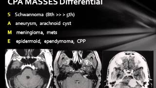 Cerebellopontine Angle Lesions [upl. by Anissa]