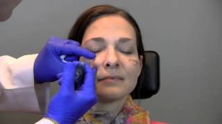 Voluma Treatment to Restore Cheek Volume [upl. by Geesey]