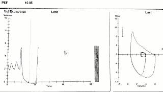 Spirometry demonstration [upl. by Koslo]