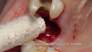 Simple Steps for GUIDOR® easy graft® Alloplastic Bone Grafting System HD [upl. by Enneicul682]