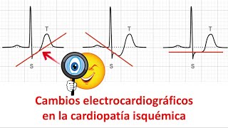 Cambios electrocardiográficos en la cardiopatía isquémica [upl. by Sudderth]