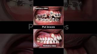 Braces are very crooked teeth braces orthodontist dentistry dentist allaboutbraces [upl. by Sualohcin13]