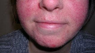 How to Treat Facial Eczema DermTVcom Epi 479 [upl. by Ausoj]