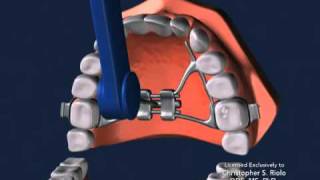 Seattle Orthodontist Dr Christopher Riolo Banded Expander RPE [upl. by Othilia]