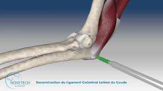 Reconstruction du ligament collatéral latéral du coude avec NOVALIG® [upl. by Aihsyn276]