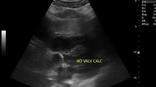 Normal vs abnormal aortic valve subcostal vs PLAX view echocardiography [upl. by Oaks21]