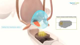 Sonablate HIFU Prostate Cancer Treatment Animation Part I amp II [upl. by Glass]