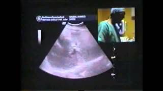 IR Liver Cancer Live Microwave Ablation Treatment without Surgery  Dr Samir Abdelghaffar [upl. by Eittod]