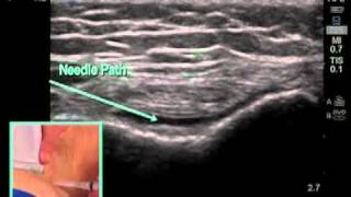 How to Ultrasound Guided Knee Injection Scanning Technique [upl. by Goeger177]