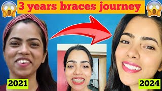 My 3 years Braces journey from 2021 to 2024before amp after teeth transformationdt Kanchan rai [upl. by Tyson]