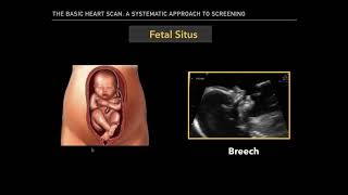 The Basic Fetal Heart Scan [upl. by Eramat220]