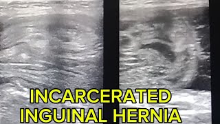 Incarcerated Inguinal Hernia What to Look For in ultrasound [upl. by Brown680]