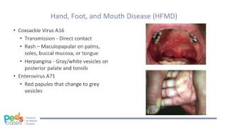 Viral Rashes in Children [upl. by Ddal]