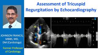 Assessment of Tricuspid Regurgitation by Echocardiography [upl. by Nosnaj214]