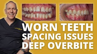 Dentistry Case Poor Aesthetics with Deep Overbite and Traumatic Occlusion [upl. by Weide]