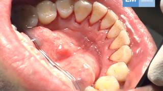 Periodontal treatment protocol [upl. by Meggs]