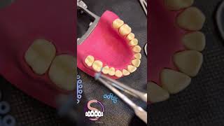 Technique for separator placement and removal dental spacersElastic separators dentist [upl. by Nesrac]