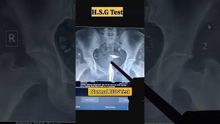 Normal HSG Test  Hysterosalpingogram  viral radiology youtubeshorts youtube radiologist [upl. by Lachus]