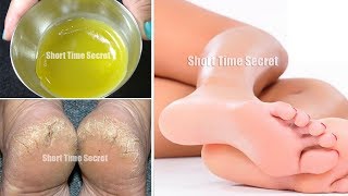 रातों रात फटी एड़ियां से छुटकारा पाये  Get Soft Smooth amp Healthy Heels in just 1 Night [upl. by Aaberg]