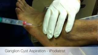 Ganglion Cyst Aspiration [upl. by Merrili]