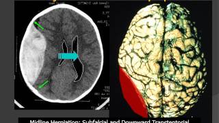 MedPix® Traumatic Brain Injury  Epidural Hematoma RadiologicPathologic Correlation [upl. by Ibbor]