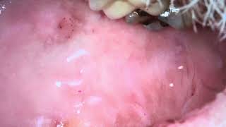 Leukoplakia oral sores part 111 [upl. by Aleedis]