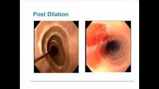 Eosinophilic Esophagitis [upl. by Havener]