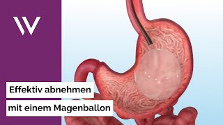 Wie einfach der Weight Doctors® Magenballon funktioniert Schonend effektiv umkehrbar [upl. by Leiser]