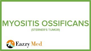 MYOSITIS OSSIFICANS STERNERS TUMOR [upl. by Girhiny478]